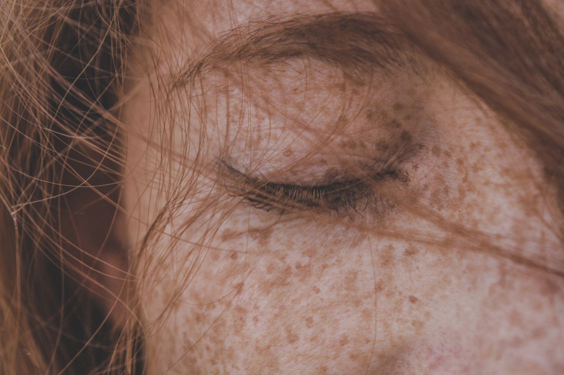Pele com melasma protegida por protetor solar, contexto de tratamento de manchas faciais
